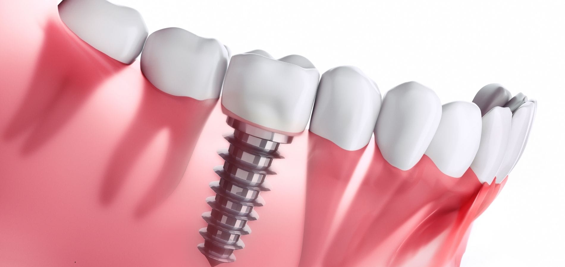 Tratamiento de implantes dentales en Valencia
