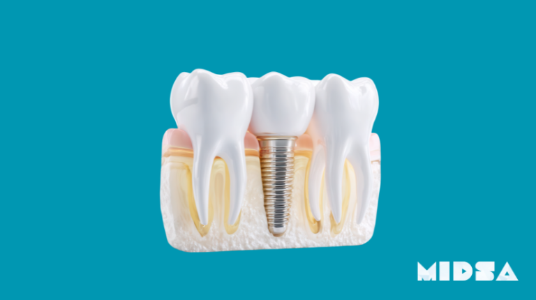 When is a dental implant necessary? A complete guide by MIDSA