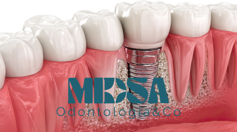 ¿Cuánto duran los implantes dentales? Todo lo que debes saber