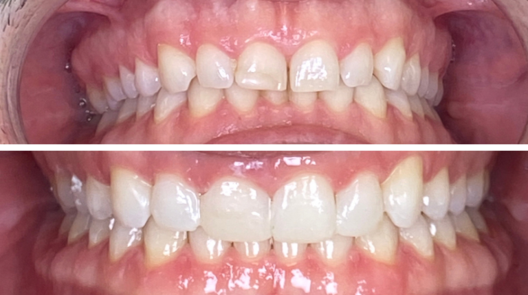 Antes y después de Invisalign en Valencia: caso real de ortodoncia invisible