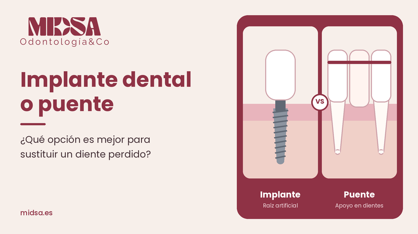 implante dental o puente en Valencia